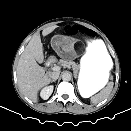 File:Colocolic intussusception due to large lipoma (Radiopaedia 68773-78482 A 43).jpg