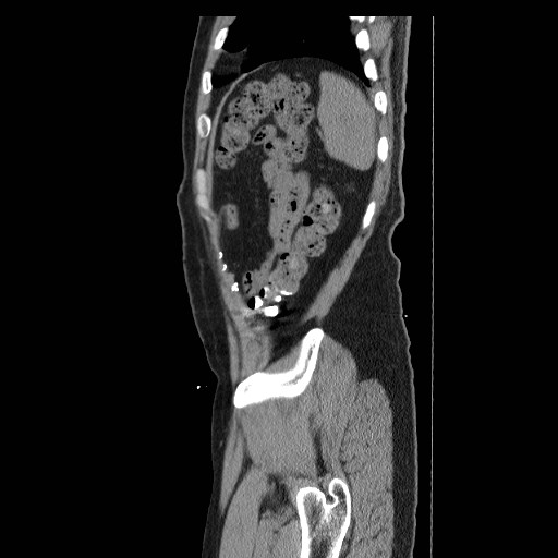 Colocutaneous fistula in Crohn's disease (Radiopaedia 29586-30093 F 49).jpg