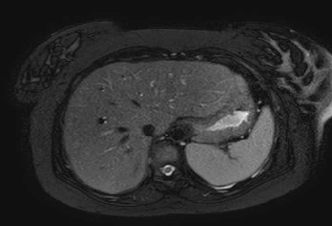 Colon adenocarcinoma with Krukenberg tumors, advanced pregnancy (Radiopaedia 67279-76645 Axial T2 SPAIR 72).jpg