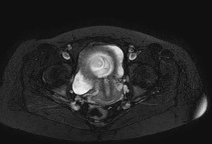 Colon adenocarcinoma with Krukenberg tumors, advanced pregnancy (Radiopaedia 67279-76645 Axial T2 SPAIR 9).jpg