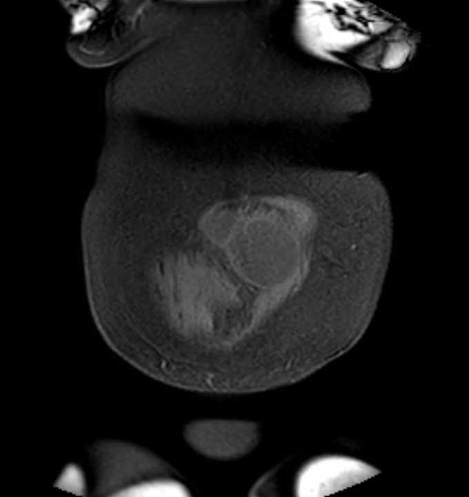 Colon adenocarcinoma with Krukenberg tumors, advanced pregnancy (Radiopaedia 67279-76645 E 2).jpg