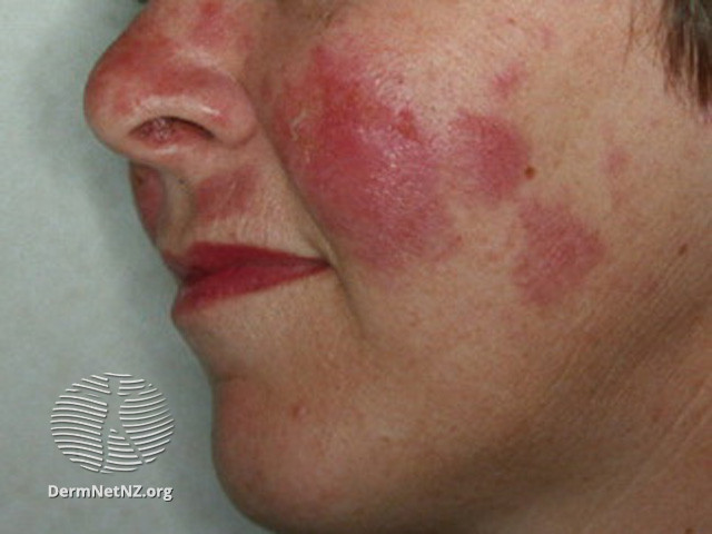 Cutaneous lupus erythematosus (DermNet NZ immune-lupus-erythematosus-2553).jpg