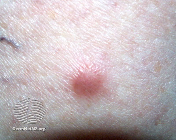 File:Dermatofibroma (DermNet NZ lesions-dermfib1).jpg