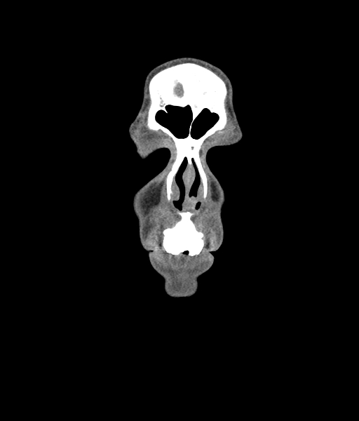 File:Nasal pyogenic granuloma (lobular capillary hemangioma) (Radiopaedia 85536-101244 D 40).jpg