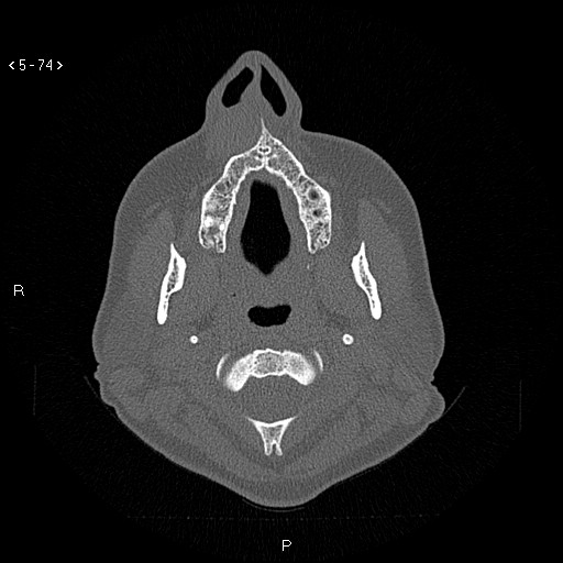 Nasolabial cyst (Radiopaedia 75125-86194 Axial bone window 35).jpg