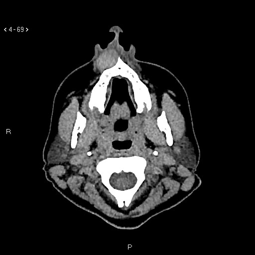 Nasolabial cyst (Radiopaedia 75125-86194 Axial non-contrast 31).jpg