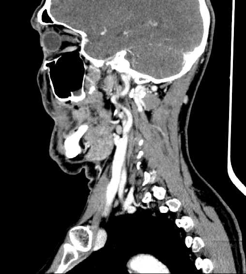 File:Nasopharyngeal carcinoma - infiltrating the clivus (Radiopaedia 62583-70875 C 36).jpg