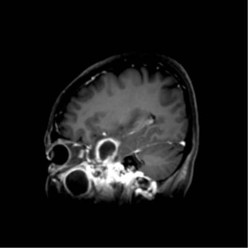 File:Nasopharyngeal carcinoma with cerebral abscess (Radiopaedia 43018-46274 J 21).png