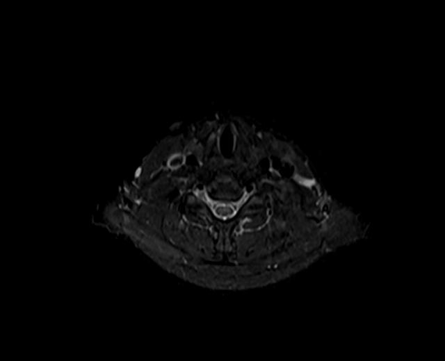 File:Nasopharyngeal carcinoma with perineural spread (Radiopaedia 55030-61380 Axial STIR 8).jpg