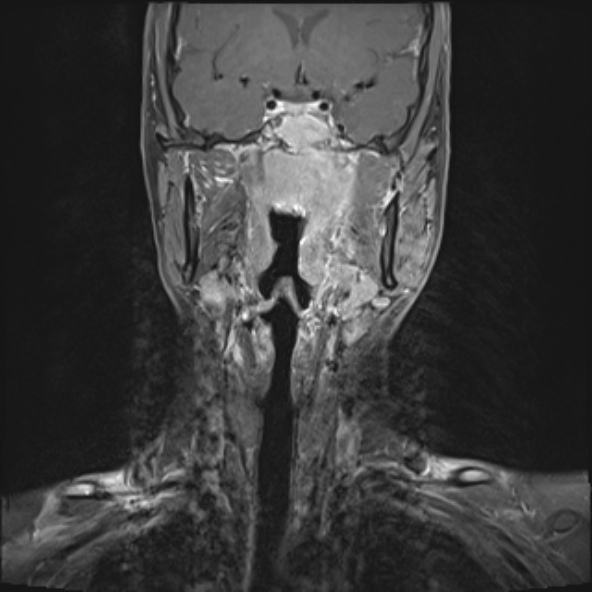 Nasopharyngeal carcinoma with skull base invasion (Radiopaedia 53415-59485 E 21).jpg