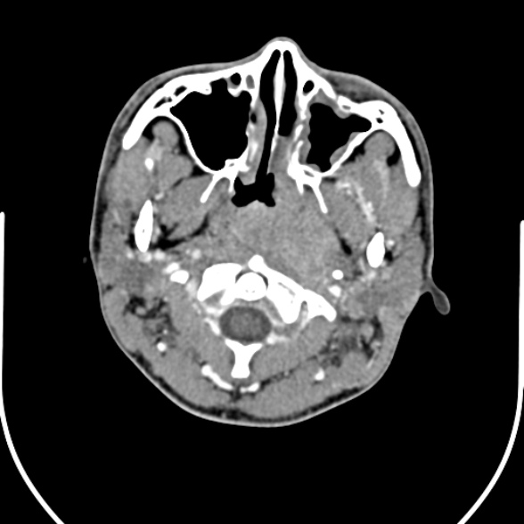Nasopharyngeal carcinoma with skull base invasion (Radiopaedia 53415-59705 A 52).jpg