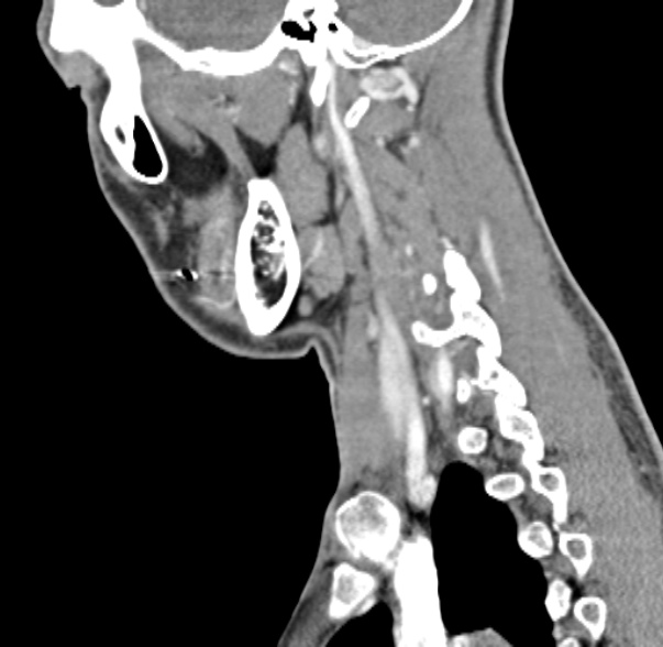 Nasopharyngeal carcinoma with skull base invasion (Radiopaedia 53415-59705 C 19).jpg