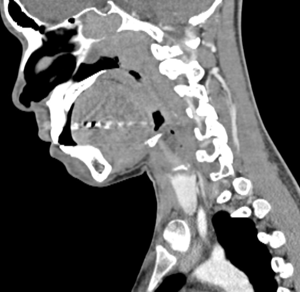 Nasopharyngeal carcinoma with skull base invasion (Radiopaedia 53415-59705 C 40).jpg