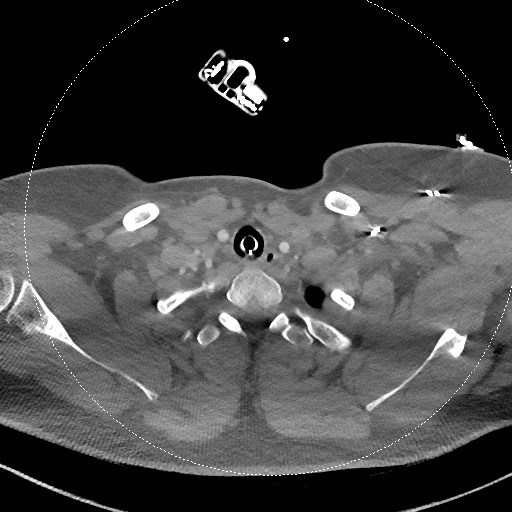 Neck CT angiogram (intraosseous vascular access) (Radiopaedia 55481-61945 B 106).jpg