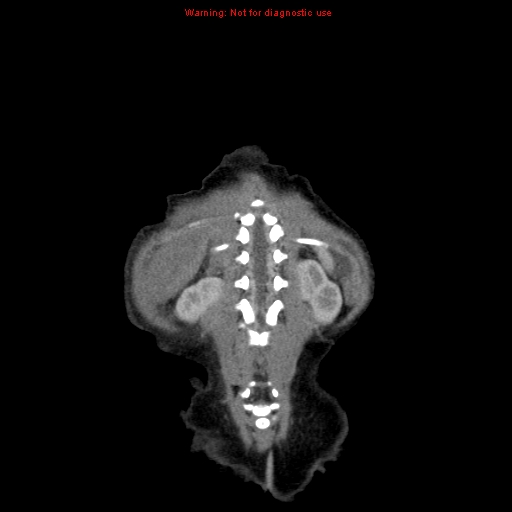 File:Neonatal neuroblastoma (Radiopaedia 9564-10223 B 104).jpg