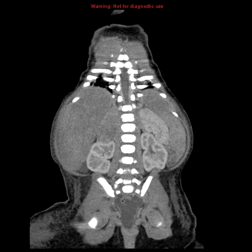 File:Neonatal neuroblastoma (Radiopaedia 9564-10223 B 94).jpg