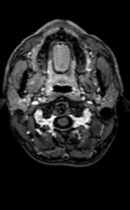 Neuro-Behçet disease (Radiopaedia 90112-107294 Axial T1 C+ 206).jpg