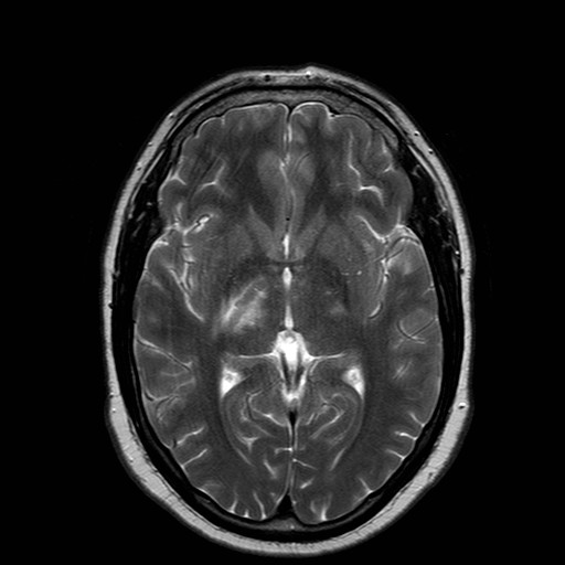 File:Neuro-Behcet's disease (Radiopaedia 21557-21505 Axial T2 11).jpg