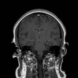 File:Neuro-Behcet's disease (Radiopaedia 21557-21505 Coronal T1 C+ 11).jpg