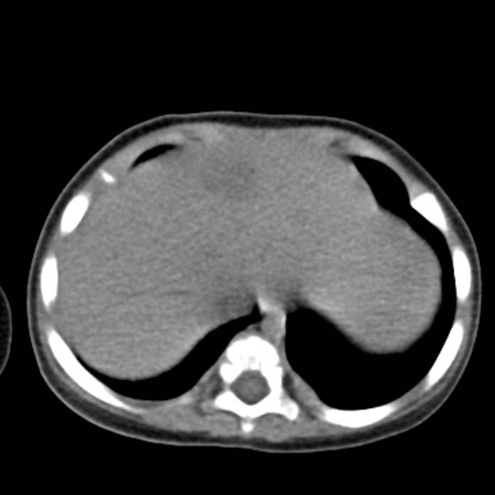 Neuroblastoma with skull metastases (Radiopaedia 30326-30960 Axial non-contrast 6).jpg