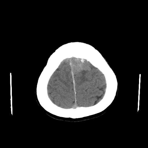 File:Neurofibromatosis type 2 (Radiopaedia 25389-25637 Axial non-contrast 24).jpg