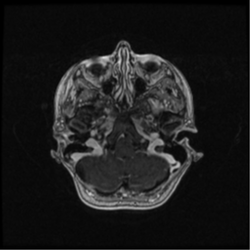 Neurofibromatosis type 2 (Radiopaedia 45229-49244 Axial T1 C+ 33).png