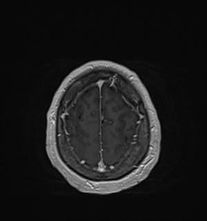 Neurofibromatosis type 2 (Radiopaedia 79097-92049 Axial T1 C+ 170).jpg