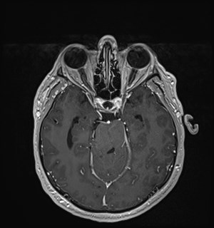 Neurofibromatosis type 2 (Radiopaedia 79097-92049 Axial T1 C+ 79).jpg