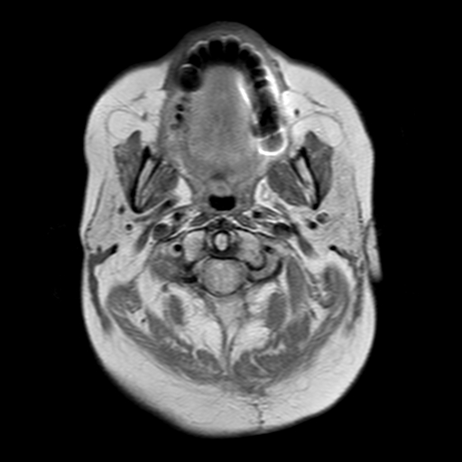 File:Neurofibromatosis type 2 (Radiopaedia 8713-9518 Axial Gradient Echo 25).jpg