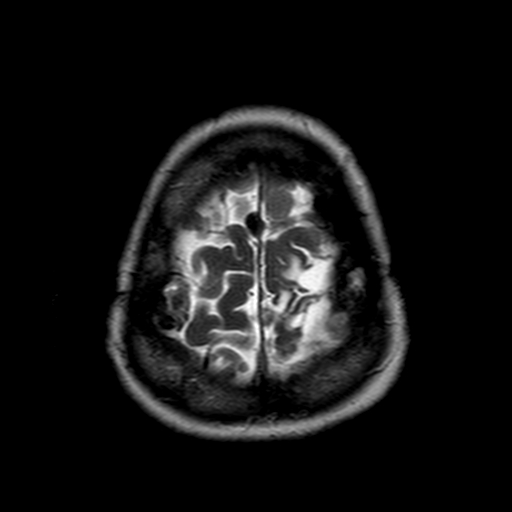 File:Neurofibromatosis type 2 (Radiopaedia 8713-9518 Axial T2 3).jpg