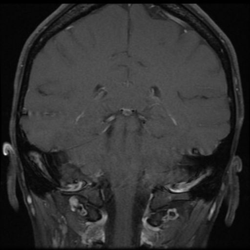 File:Neurofibromatosis type 2 - bilateral acoustic neuromata (Radiopaedia 40060-42566 Coronal T1 C+ 3).png