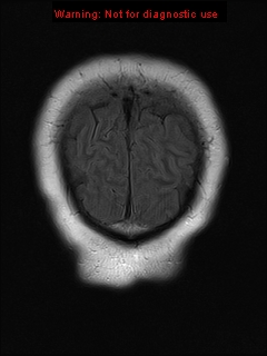 File:Neuroglial cyst (Radiopaedia 10713-11184 Coronal FLAIR 3).jpg