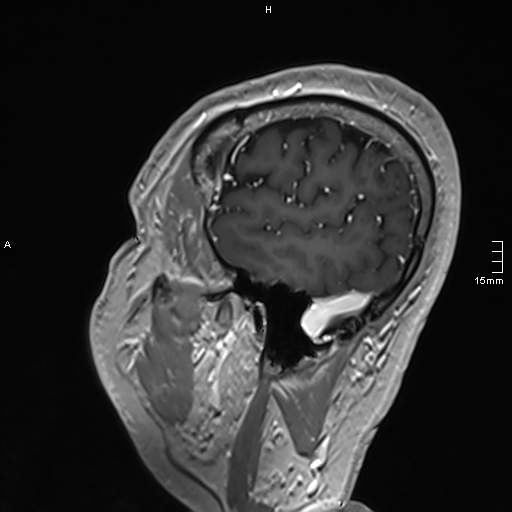 Neurosarcoidosis - involvement of the mesial temporal lobes (Radiopaedia 67429-76820 Sagittal T1 C+ 142).jpg
