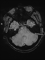 File:Neurotoxoplasmosis - concentric target sign (Radiopaedia 70644-80784 Axial SWI 11).jpg