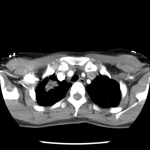File:Non-small cell lung cancer with miliary metastases (Radiopaedia 23995-24193 A 11).jpg