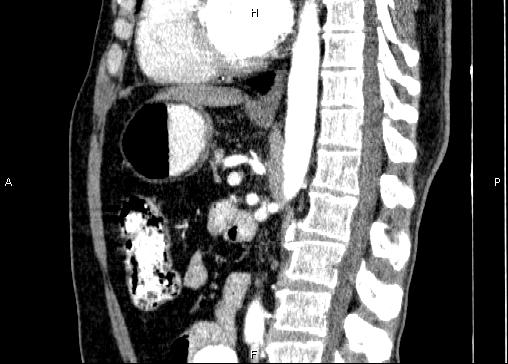 Non-syndromic pancreatic endocrine tumor (Radiopaedia 86958-103178 E 56).jpg