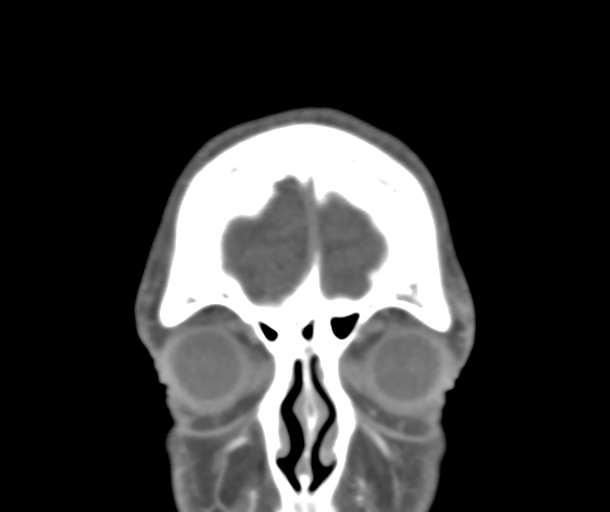 File:Normal CTA head (Radiopaedia 40801-43464 B 13).png