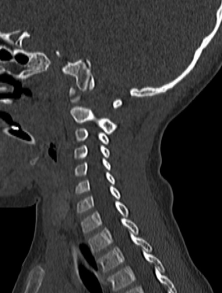 Normal CT cervical spine - pediatric (Radiopaedia 52549-58462 Sagittal bone window 67).jpg