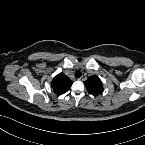 Normal CT chest- adult female (Radiopaedia 52522-58428 Axial non-contrast 20).jpg