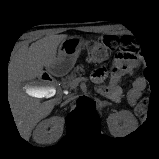 File:Normal CT intravenous cholangiogram (Radiopaedia 38199-40208 Axial IVC (MIP) 39).png
