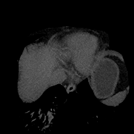File:Normal CT intravenous cholangiogram (Radiopaedia 38199-40208 Axial IVC (MIP) 88).png