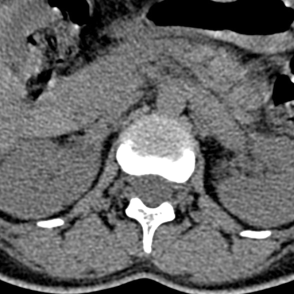 Normal CT lumbar spine (Radiopaedia 53981-60118 Axial non-contrast 22).jpg