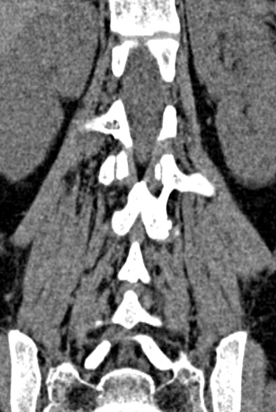 Normal CT lumbar spine (Radiopaedia 53981-60118 F 65).jpg