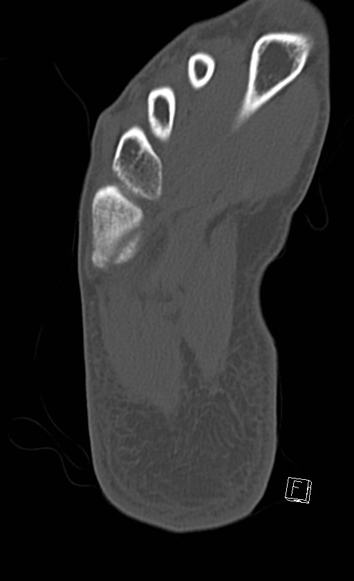Normal CT of the ankle (Radiopaedia 47111-51658 Axial bone window 90).jpg