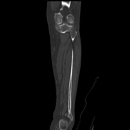 Normal CT tibia and fibula (Radiopaedia 51195-56848 Coronal non-contrast 42).jpg