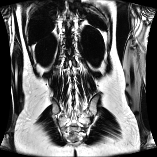 Normal MRI abdomen in pregnancy (Radiopaedia 88001-104541 N 111).jpg