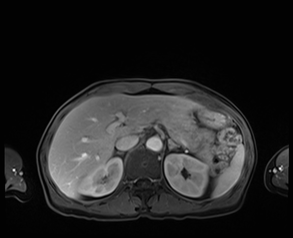 Normal adrenal glands MRI (Radiopaedia 82017-96004 K 26).jpg