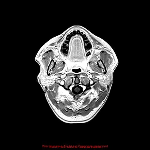 Normal adult brain MRI (non-enhanced and contrast-enhanced) (Radiopaedia 75262-86379 Axial T1 C+ 29).jpg