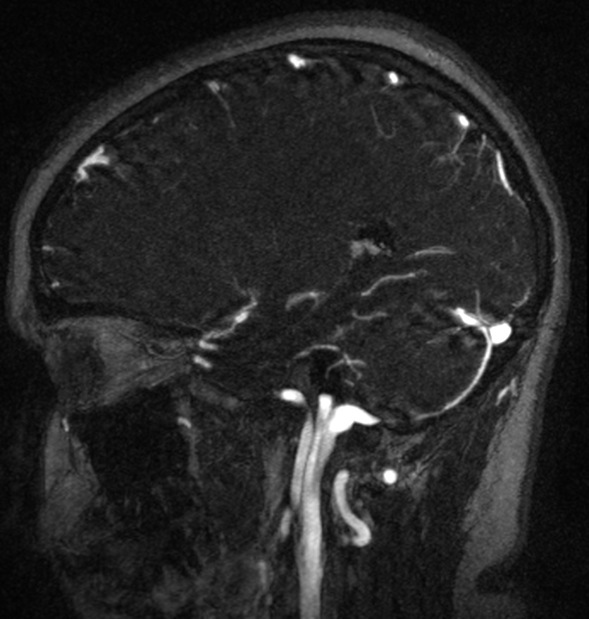 Normal brain MRI and venogram (Radiopaedia 39554-41862 Sagittal MRV 22).jpg