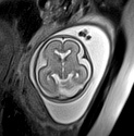 File:Normal brain fetal MRI - 22 weeks (Radiopaedia 50623-56050 Axial T2 Haste 8).jpg